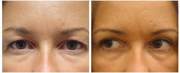 blepharoplastie tunesien vorher nachher